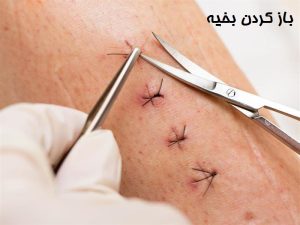 نحوه باز کردن بخیه
