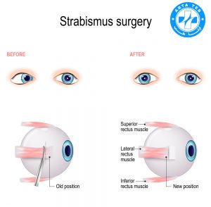 روش های درمان تنبلی چشم در کودکان برای والدین آرتا طب 19