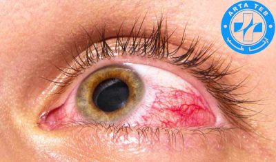 کاغذ فلورسین چیست؟ و پزشک ها چه زمانی از آن استفاده میکنند! (2)