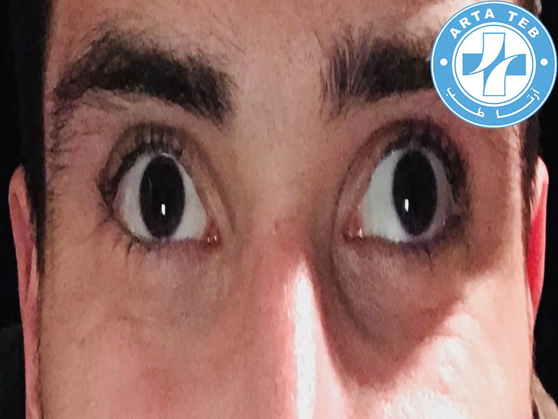 تنبلی چشم در بزرگسالان