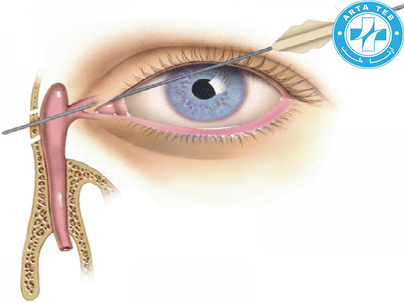 لوله کرافورد چیست