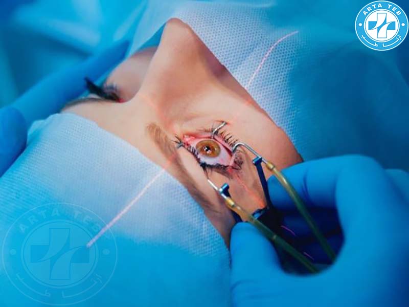 شان چشمی استریل